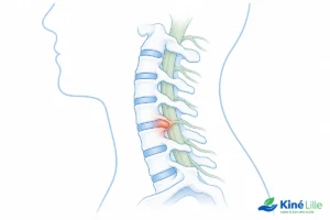 Colonne cervicale avec un disque hernié, illustrant quel sport pratiquer avec une hernie discale cervicale